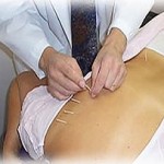 Acupuncture For Weight Loss - How Does It Work